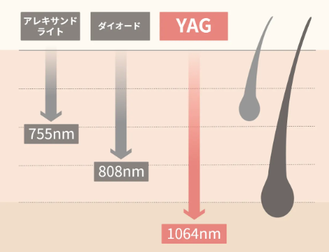 レーザーの種類のキャプチャ