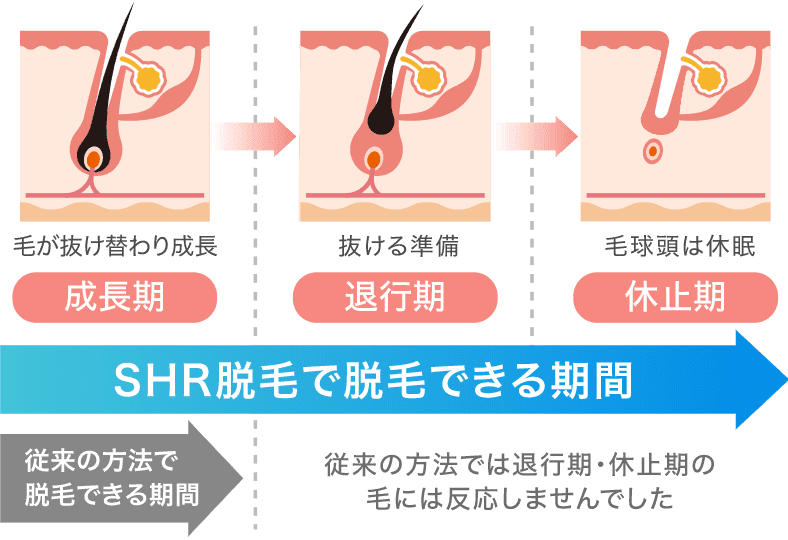 おすすめの全身脱毛 SHR方式の画像