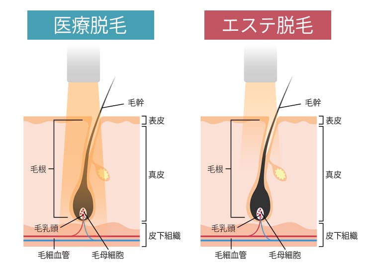 おすすめの全身脱毛の比較画像